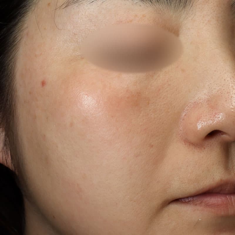 20251223_N43267_picolaser①After