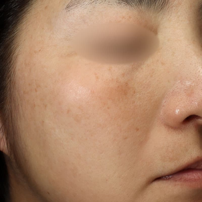 20251223_N43267_picolaser①Before