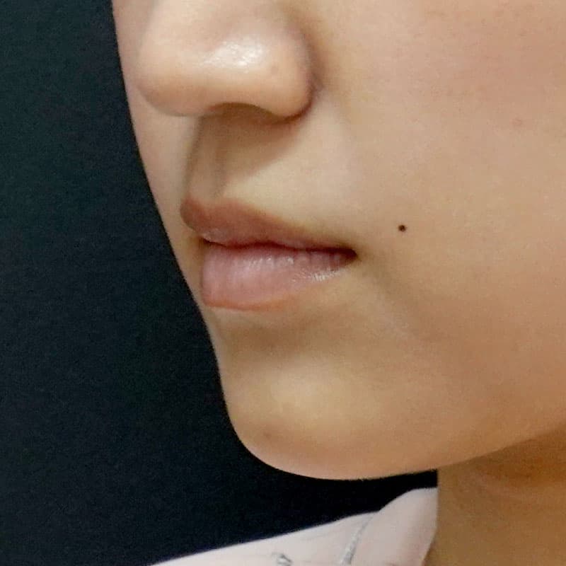 20251224_St20251224_fukuda_corner-of-mouth-botox①Before