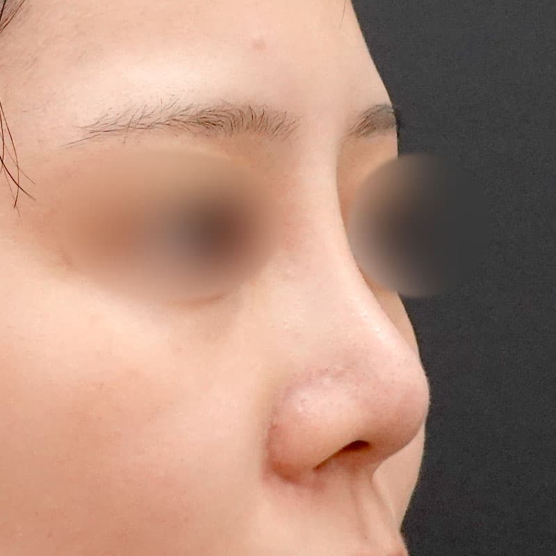 20251226_F145607_nagahama_nose-prosthesis①After