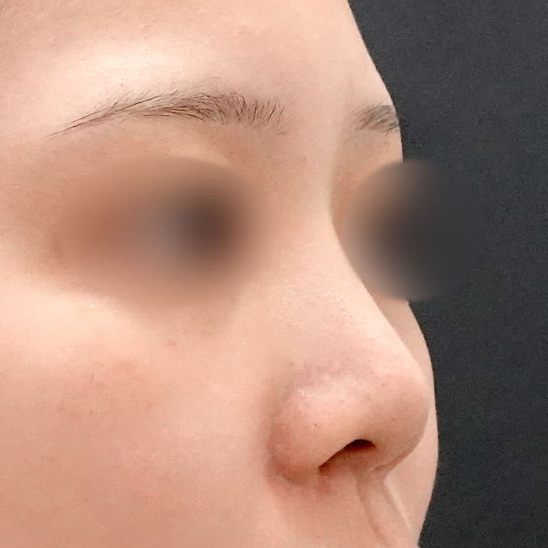 20251226_F145607_nagahama_nose-prosthesis①Before