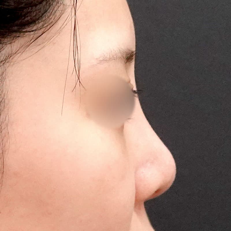 20251226_F145607_nagahama_nose-prosthesis②After