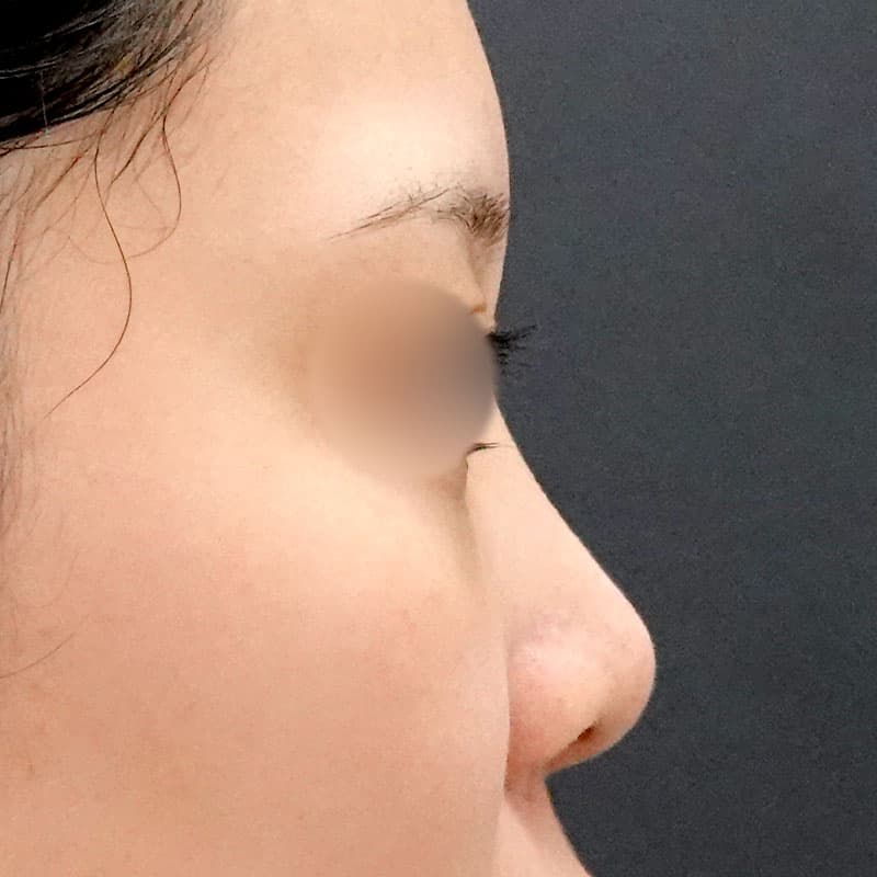 20251226_F145607_nagahama_nose-prosthesis②Before