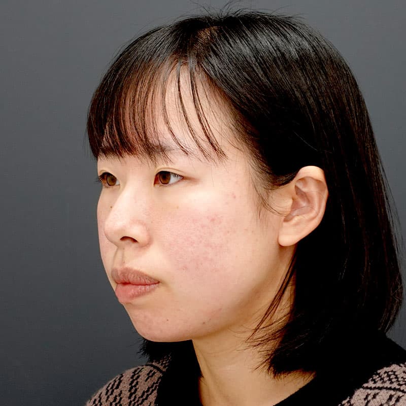 20251226_N40751_kaneko_chin prosthesis①Before