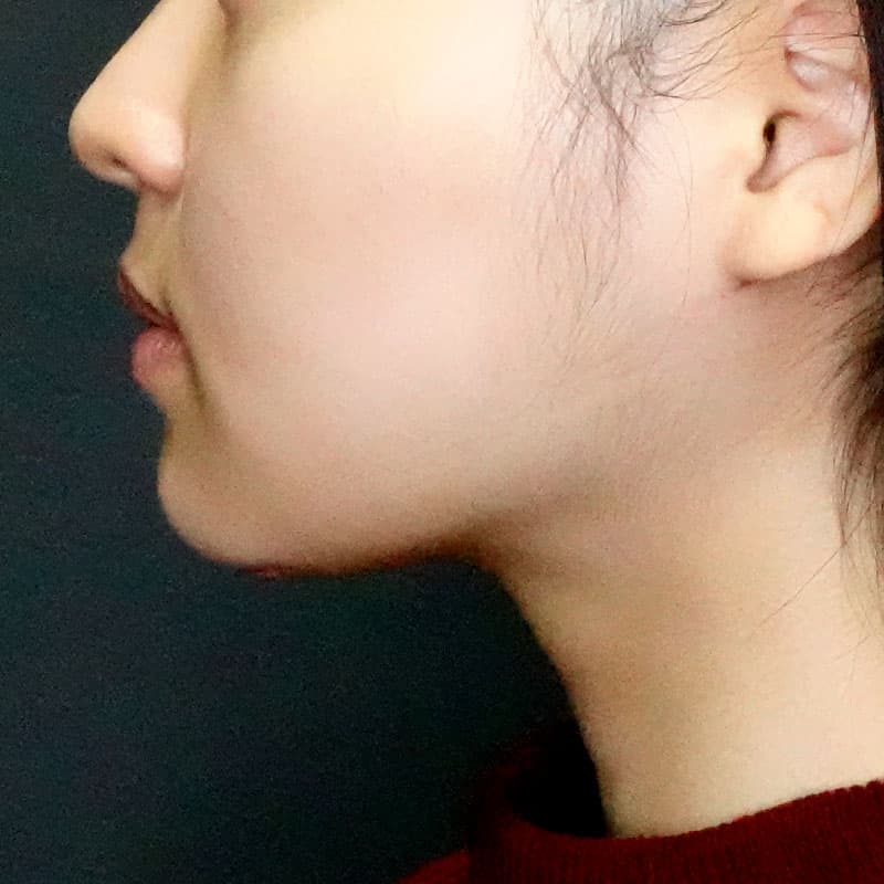 20260104_G113554_ishihara_face-liposuction_masseter-muscle-botox①After