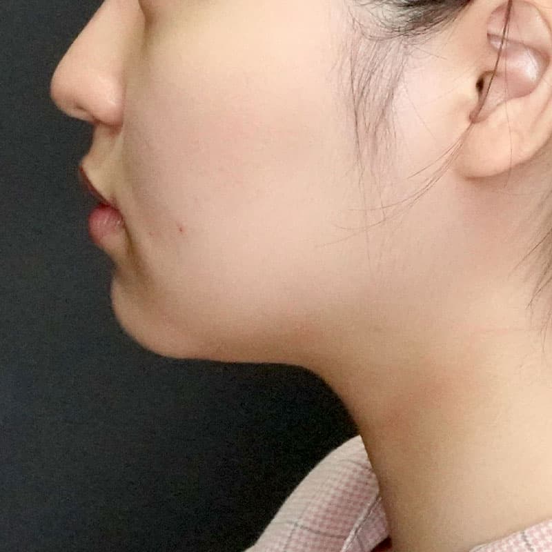 20260104_G113554_ishihara_face-liposuction_masseter-muscle-botox①Before