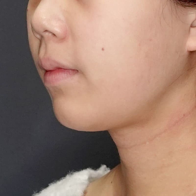 20260104_G15211_ishihara_face-liposuction_masseter-muscle-botox①After