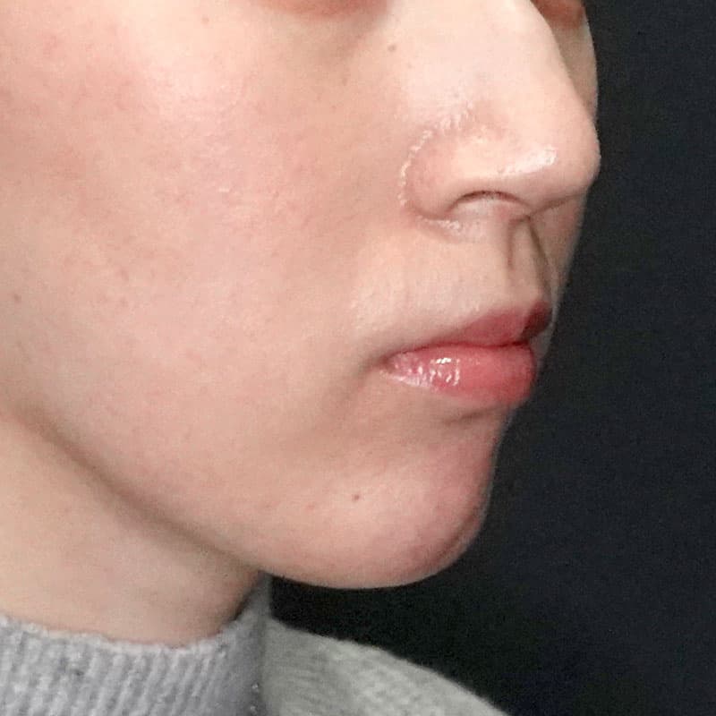 20260104_G22305_ishihara_face-liposuction_masseter-muscle-botox①After