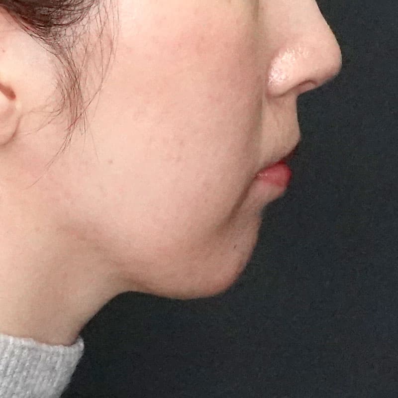 20260104_G22305_ishihara_face-liposuction_masseter-muscle-botox②After