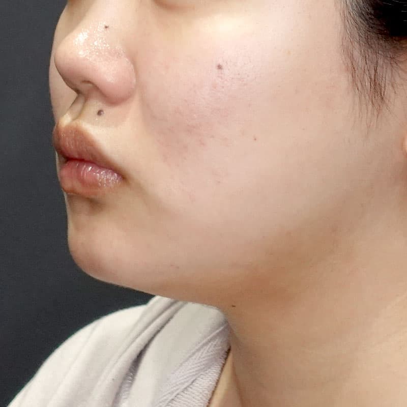 20260104_G35694_ishihara_face-liposuction_masseter-muscle-botox①After