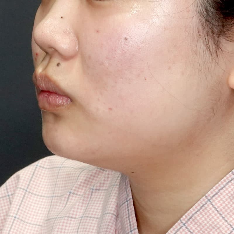 20260104_G35694_ishihara_face-liposuction_masseter-muscle-botox①Before