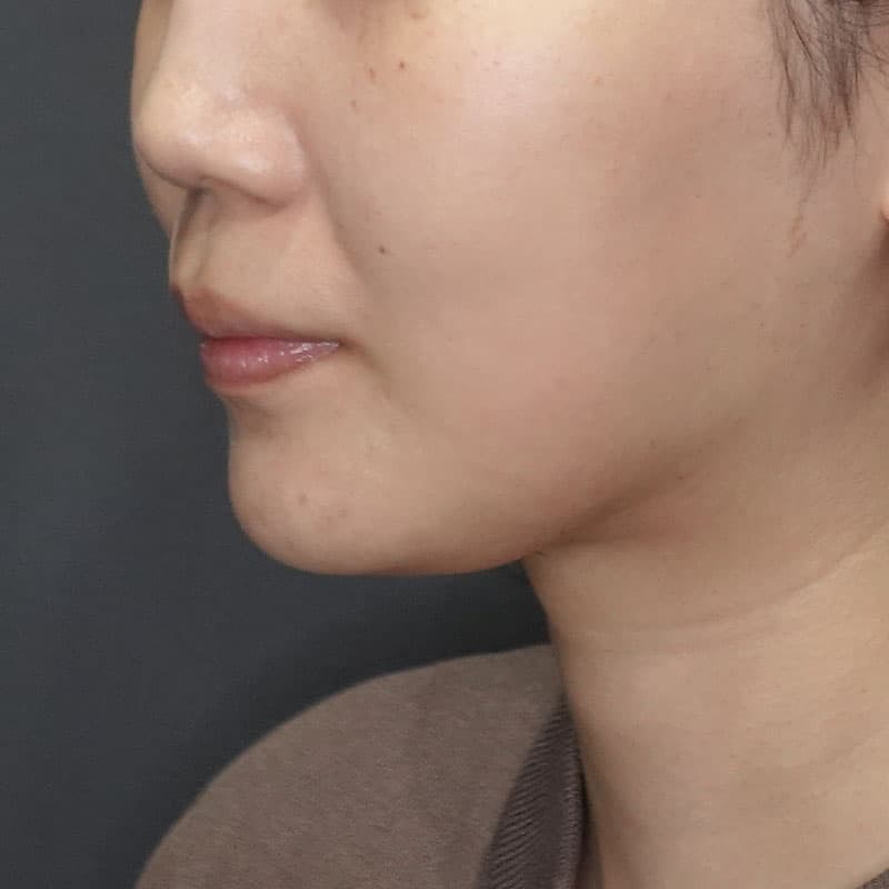 20260104_G37987_ishihara_face-liposuction_masseter-muscle-botox①After