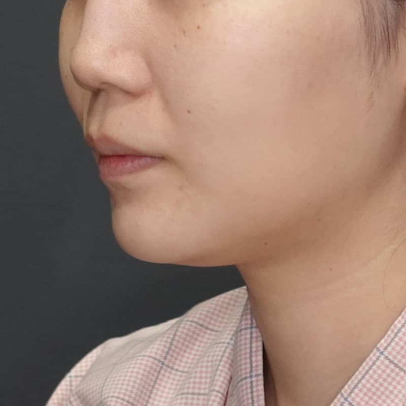 20260104_G37987_ishihara_face-liposuction_masseter-muscle-botox①Before
