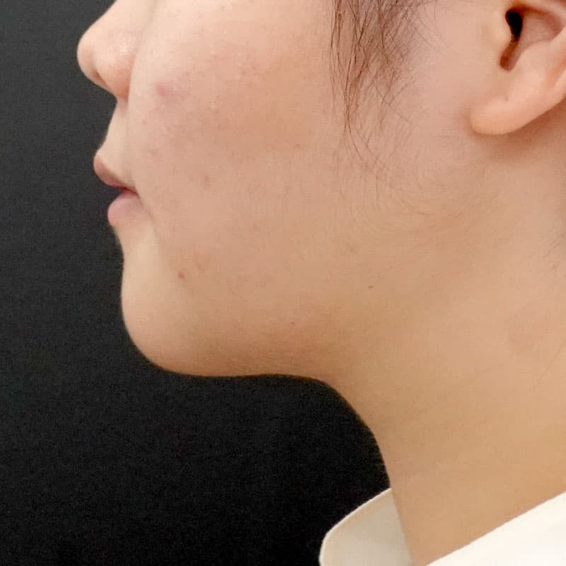 20260111_F136937_nagahama_face-liposuction_philtrum-botox②After