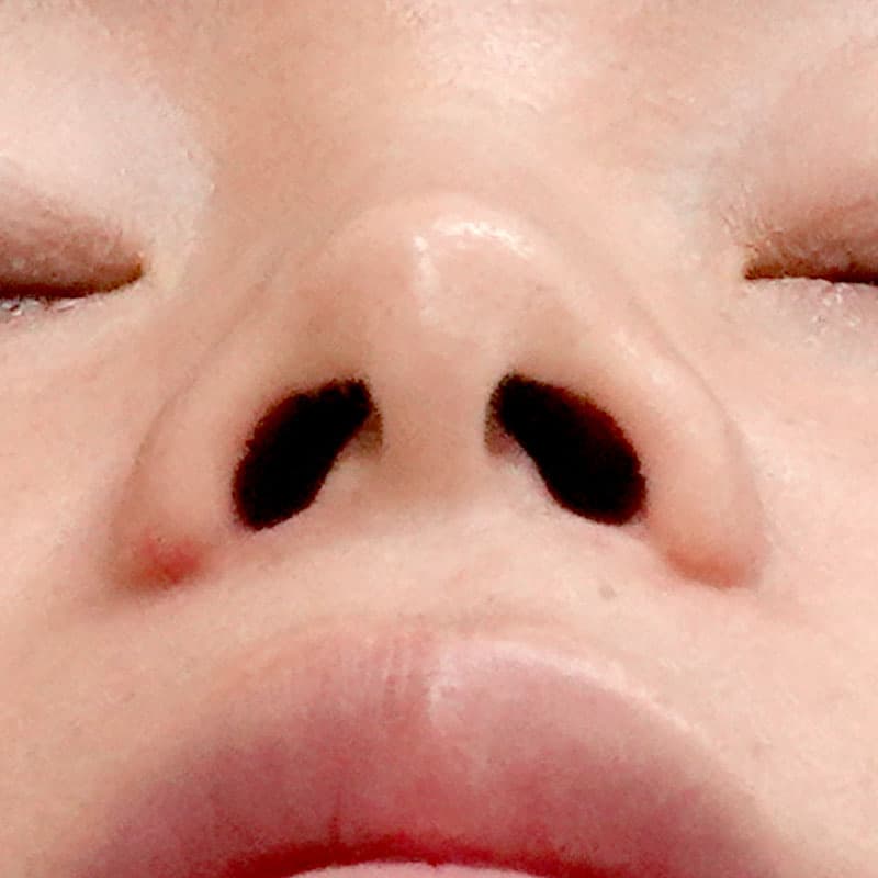 20260111_F145700_nagahama_nostril reduction①After