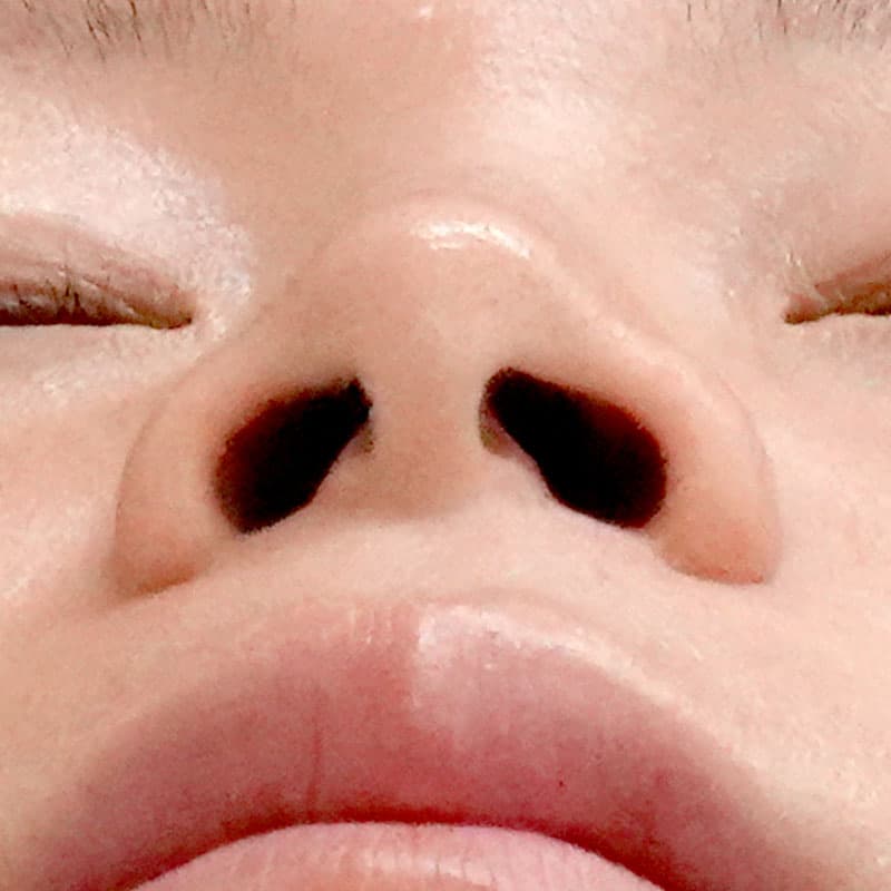 20260111_F145700_nagahama_nostril reduction①Before