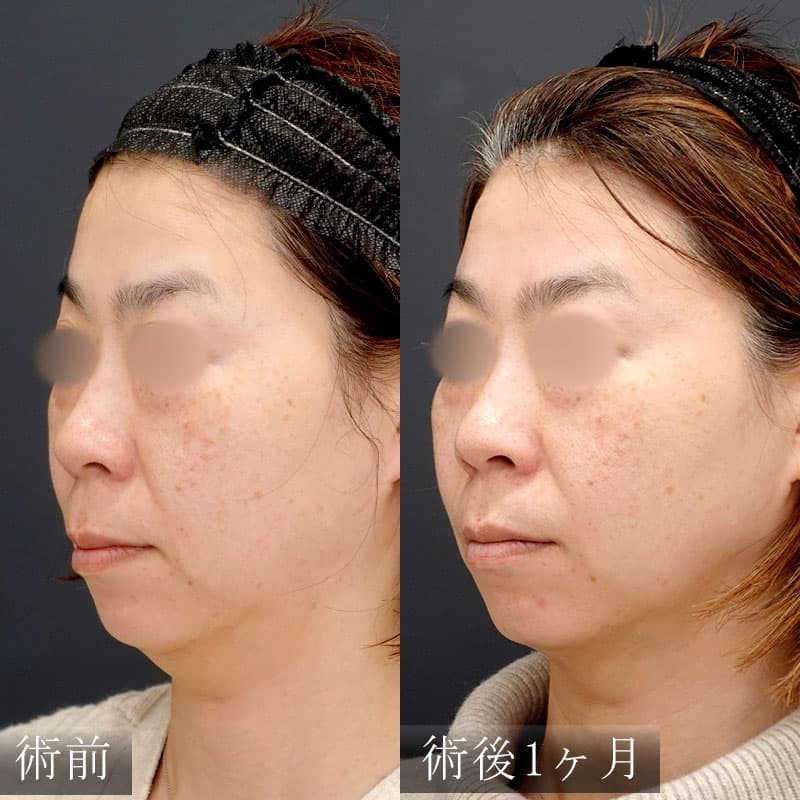 20260111_N119240_volformerメイン縦