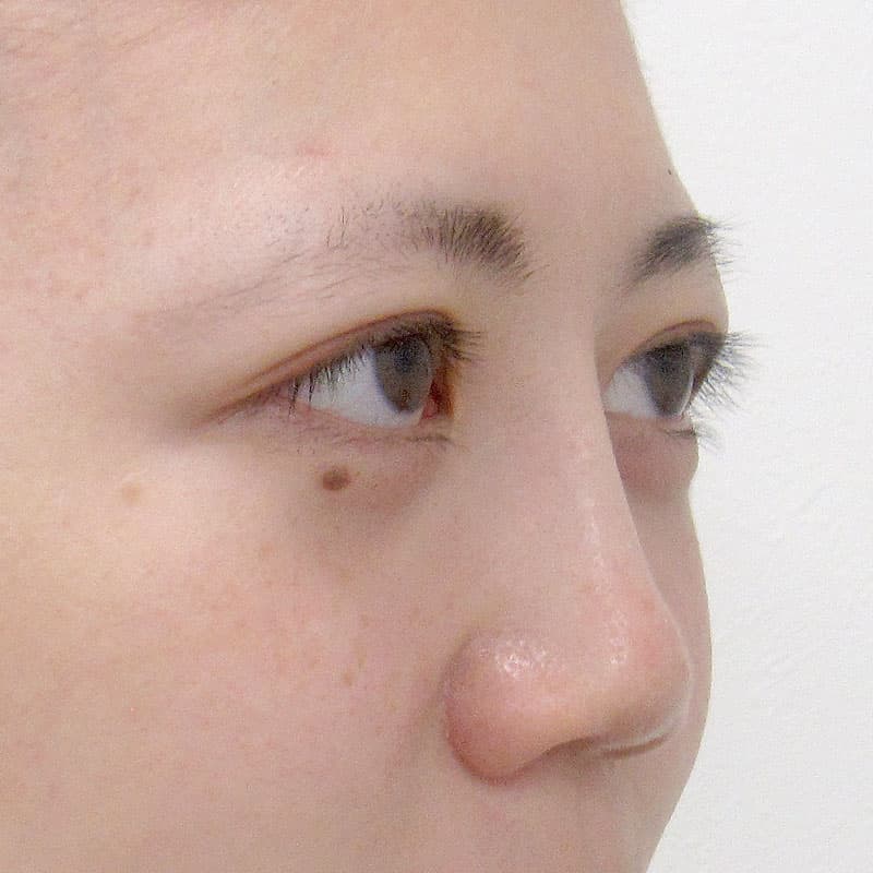 20260111_S5851_suzuki_nose-prosthesis①After