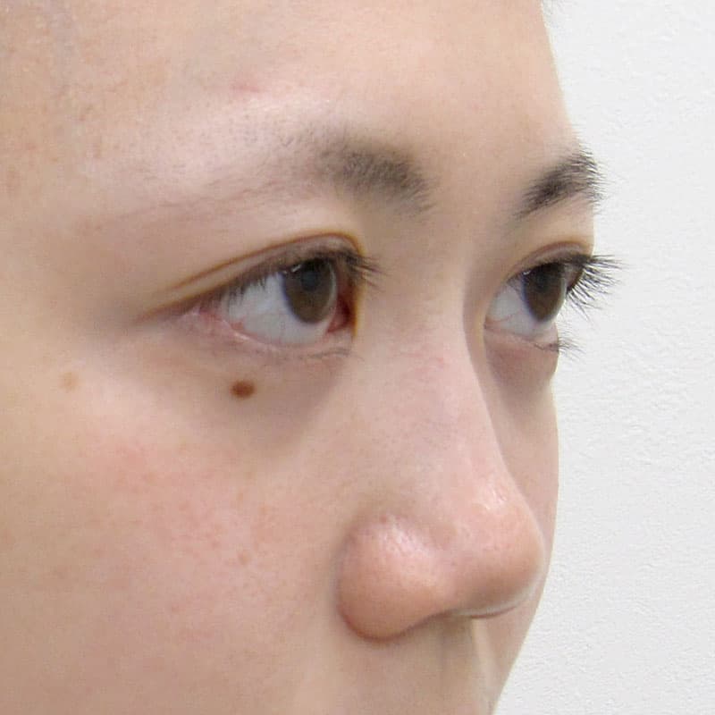 20260111_S5851_suzuki_nose-prosthesis①Before