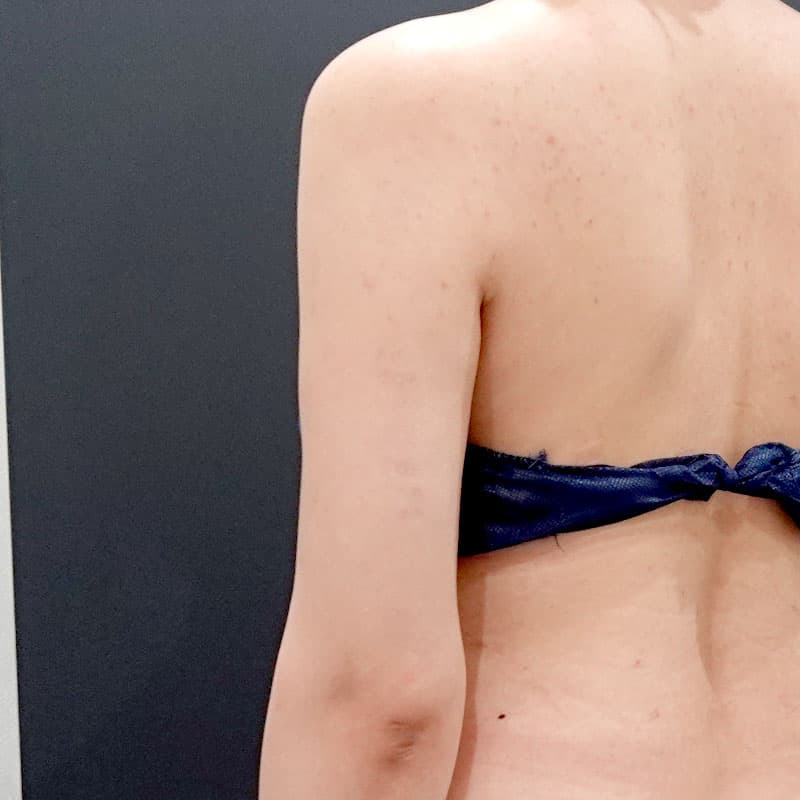 20260119_F127592_nagahama_arm-liposuction①After