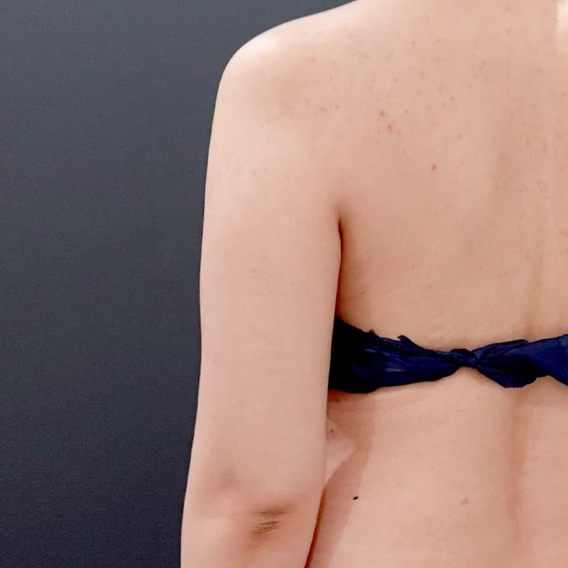 20260119_F127592_nagahama_arm-liposuction①Before