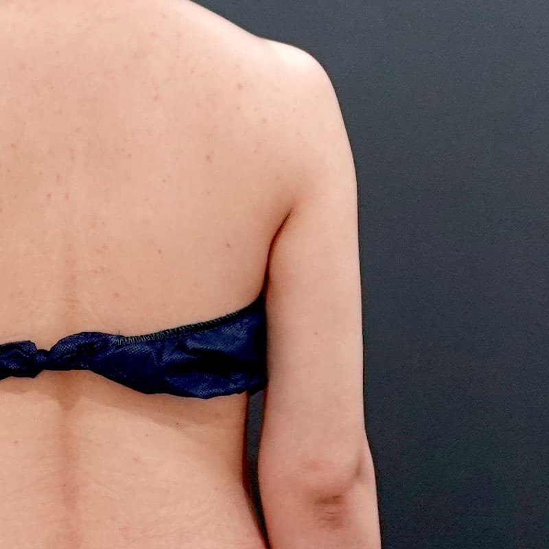 20260119_F127592_nagahama_arm-liposuction②After