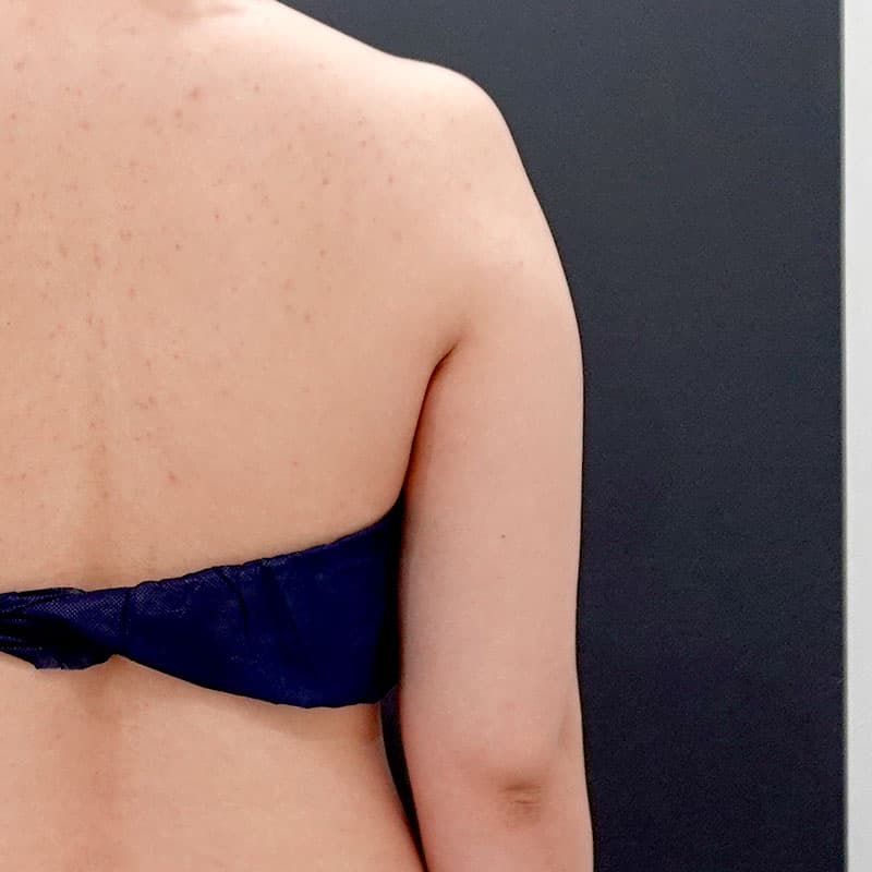 20260119_F127592_nagahama_arm-liposuction②Before