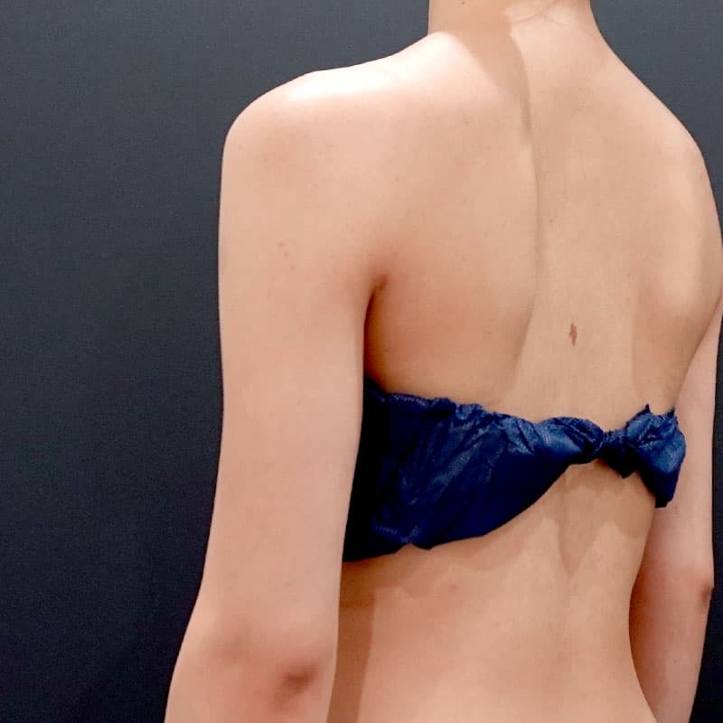 20260119_F139958_nagahama_arm-liposuction①After
