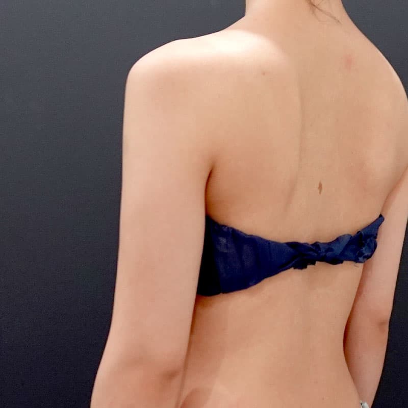 20260119_F139958_nagahama_arm-liposuction①Before