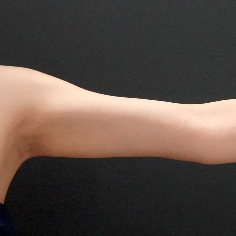 20260119_F6795_nagahama_arm-liposuction①After