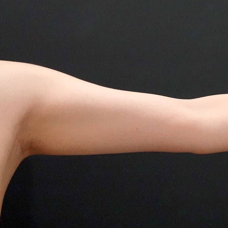 20260119_F6795_nagahama_arm-liposuction①Before