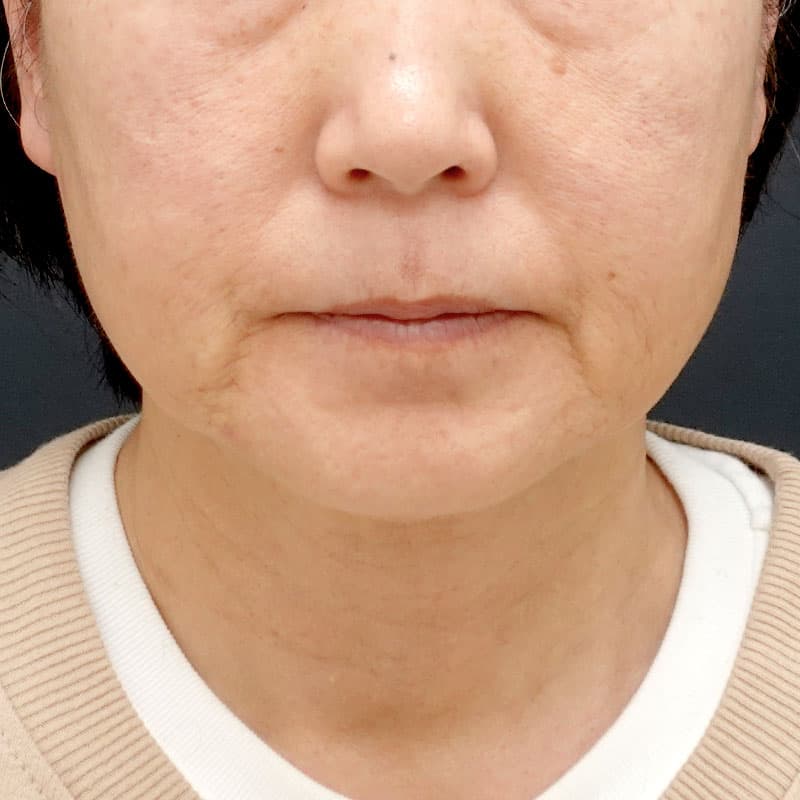 20260120_N50028_hifu-ultraformermpt①Before