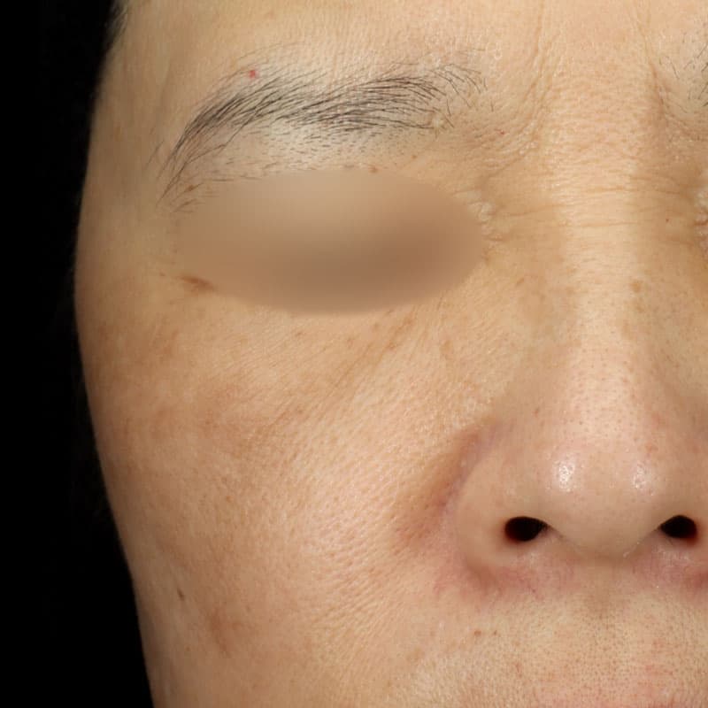 20260131_G129294__picolaser①After