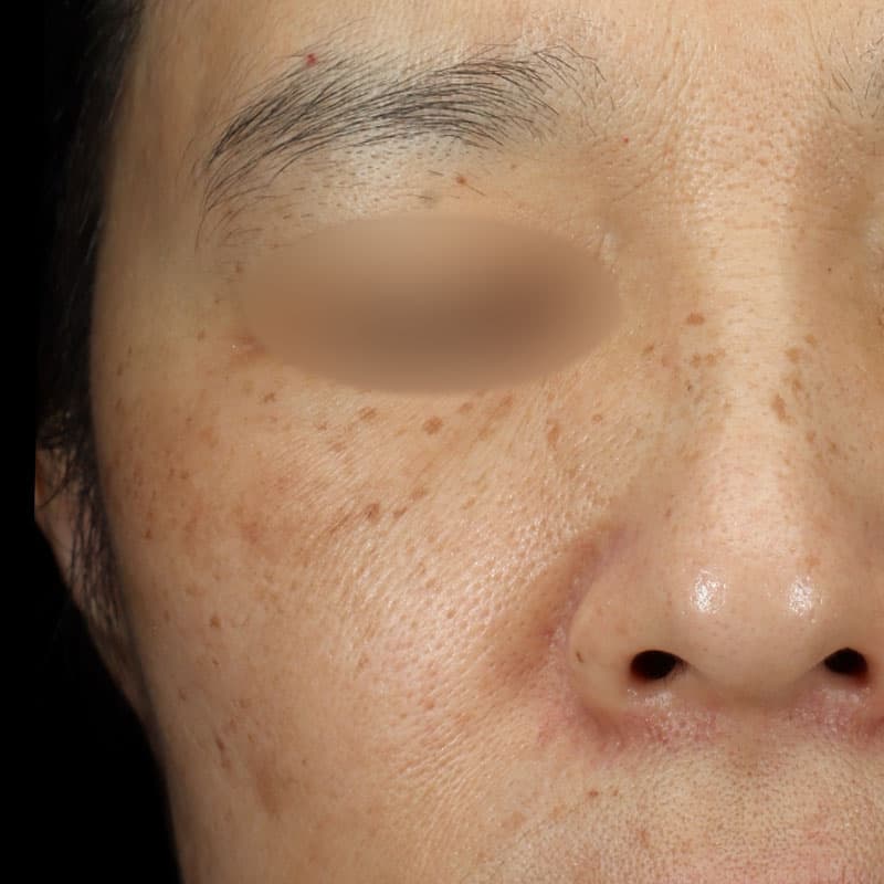 20260131_G129294__picolaser①Before