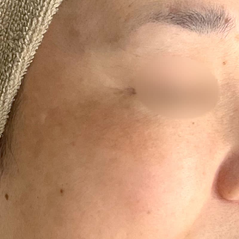 20260131_N109666_picolaser_mesonaj①After