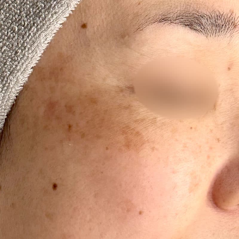 20260131_N109666_picolaser_mesonaj①Before