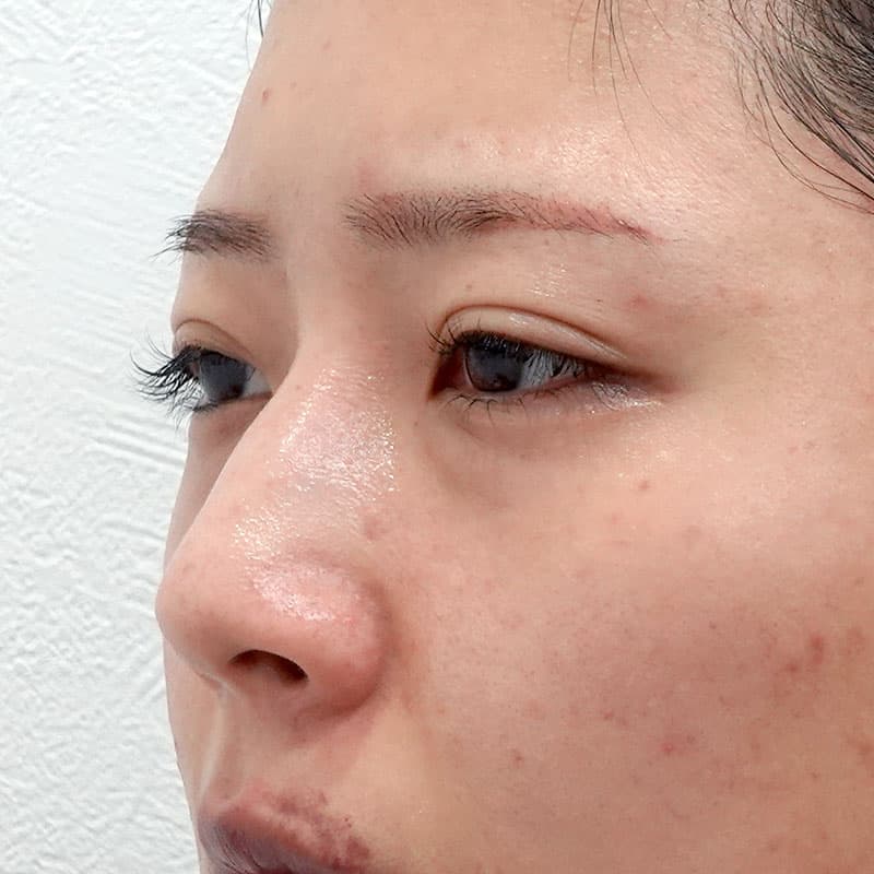 20260210_G114369_ishihara_back-hamura-method①Before