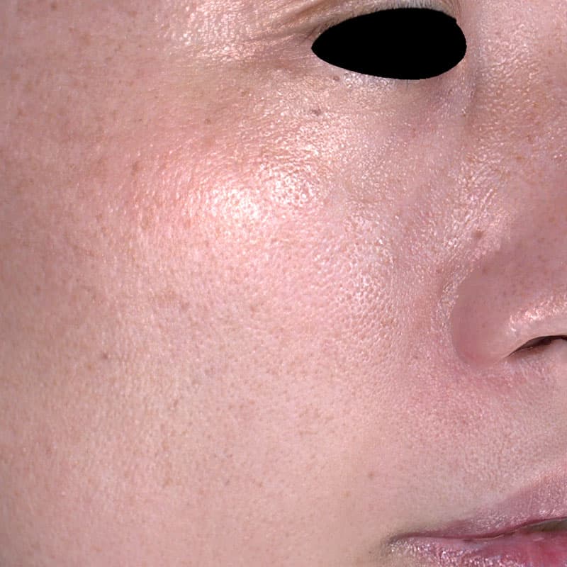 20260214_H155960_fukuda_picolaser②After