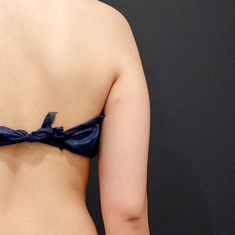 20260214_O100652_kaneko_arm-liposuction①Before