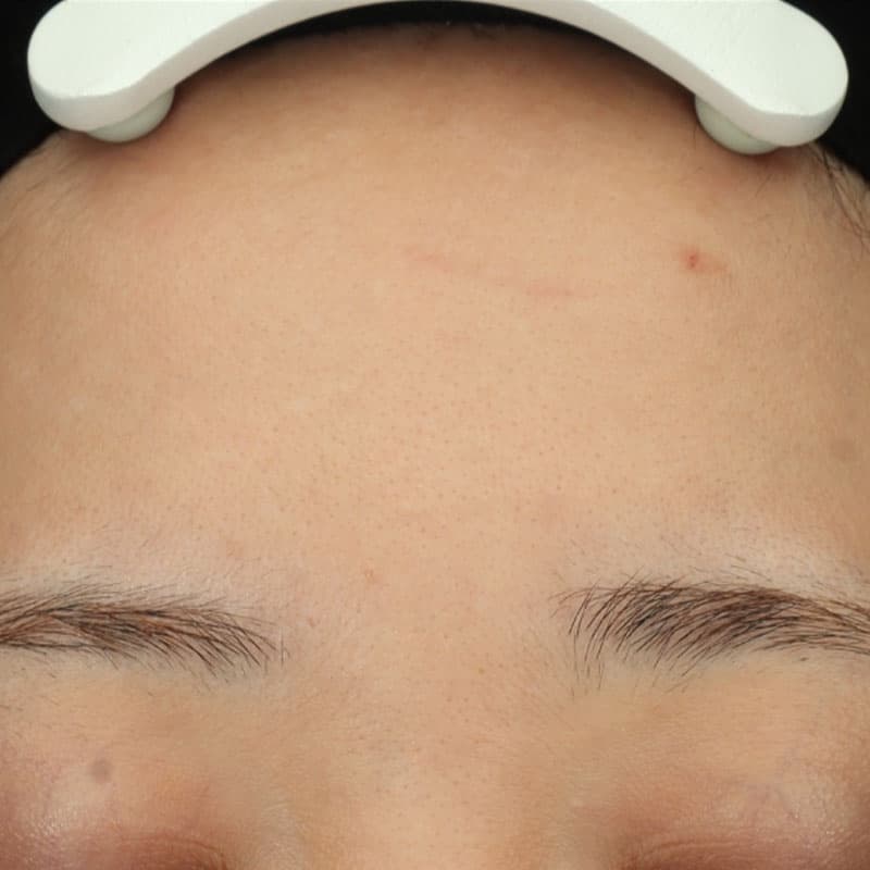 20260216_G151199_hydra booster-blessing-mesonaj①Before