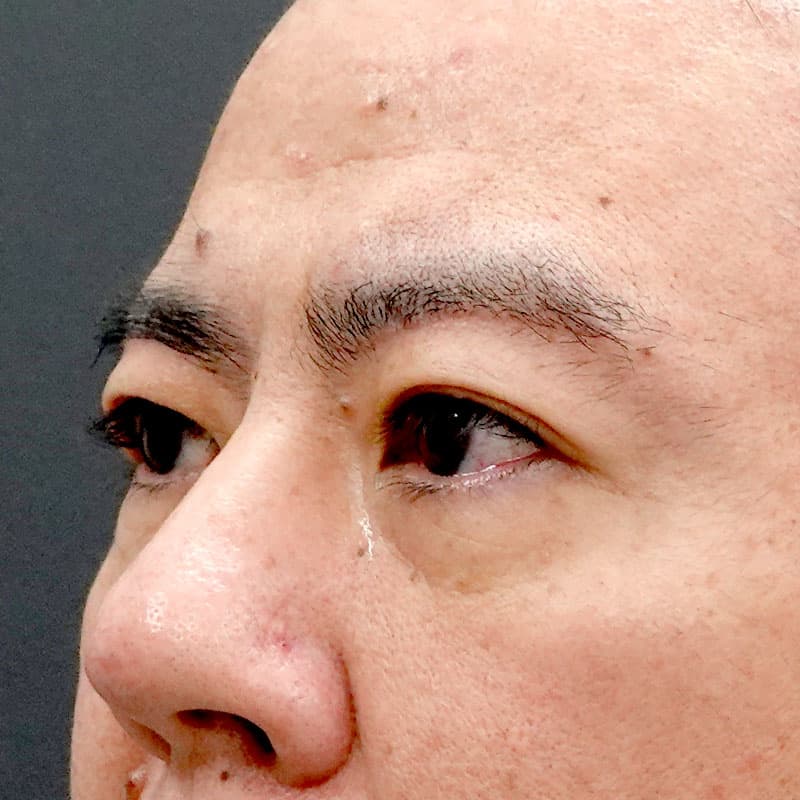 20260221_O146292_sugishima_under-eyebrow incision①After