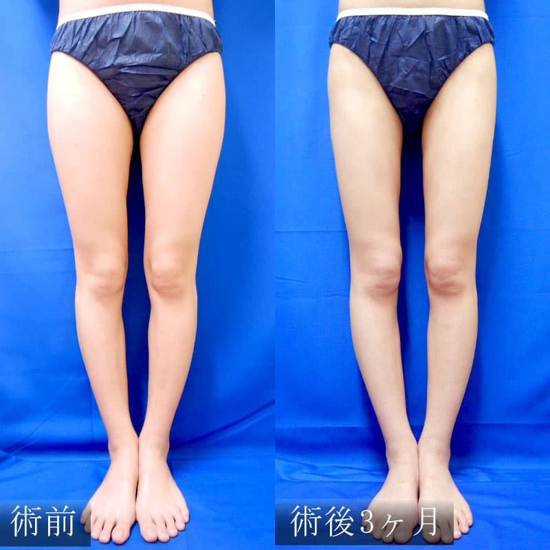 太ももの脂肪吸引 症例1