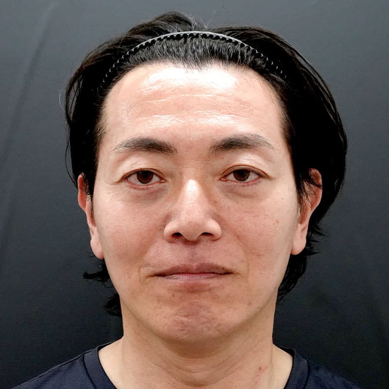 20260315_F7696_kaneko_face lift①After