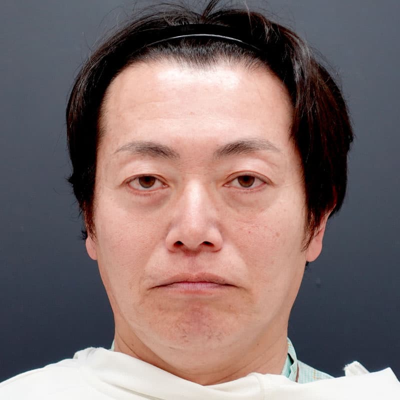 20260315_F7696_kaneko_face lift①Before