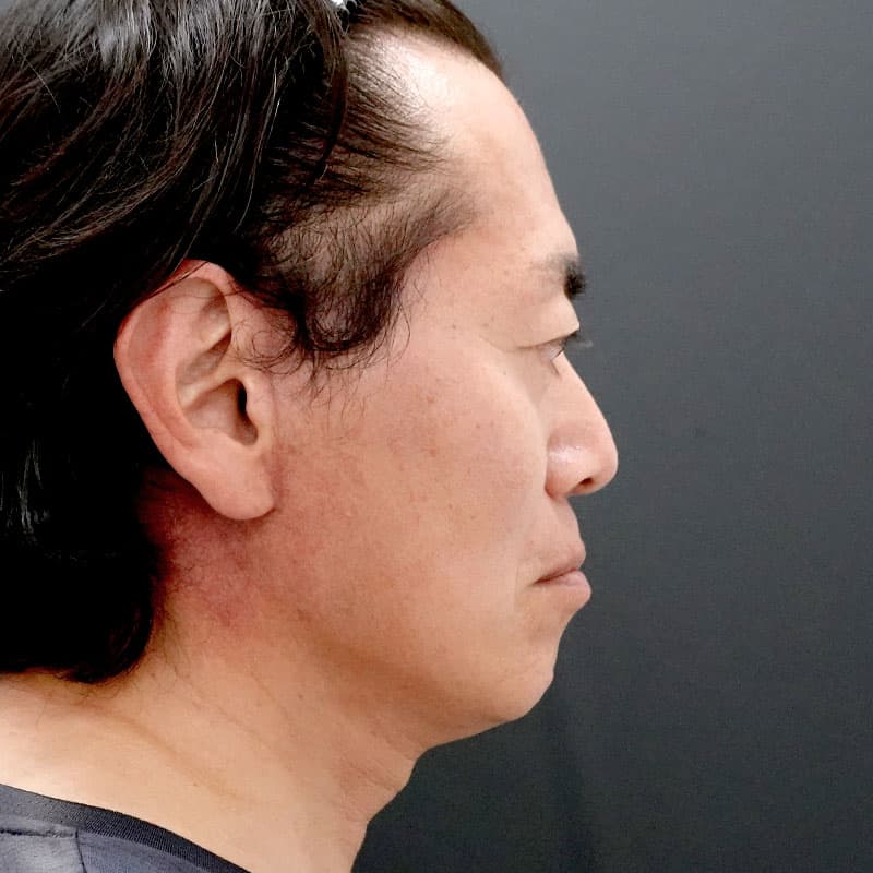 20260315_F7696_kaneko_face lift②After