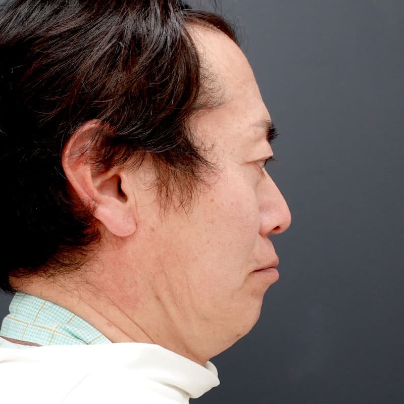 20260315_F7696_kaneko_face lift②Before