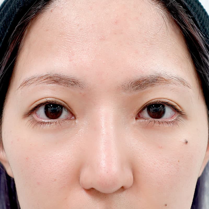 20260315_G15042_furumura_nose-prosthesis①After