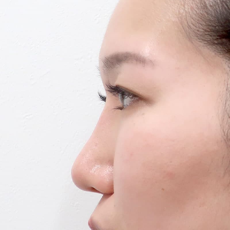 20260315_G15336_furumura_nose-prosthesis①After