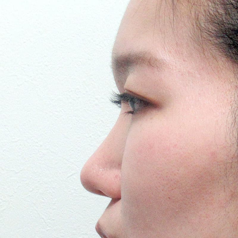 20260315_G15336_furumura_nose-prosthesis①Before