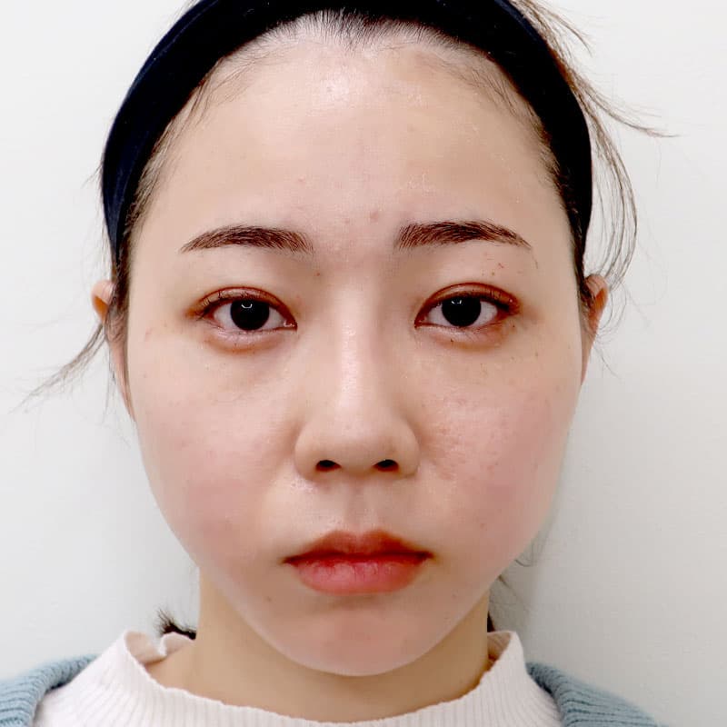 20260315_G23705_furumura_nose-prosthesis②After